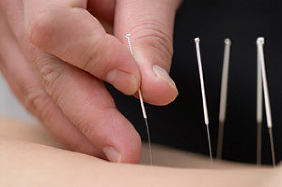 IVF Acupuncture